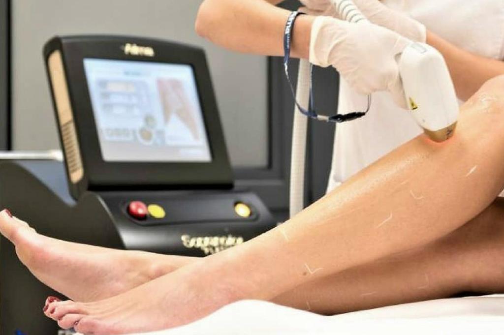 laser hair removal